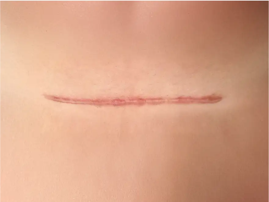 Scar
